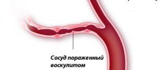 Течение болезни