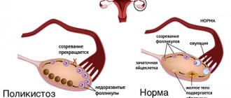 Течение овуляции в норме и при СПКЯ