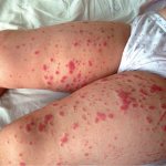 Thrombocytopenia in children