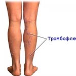 Тромбофлебит нижних конечностей