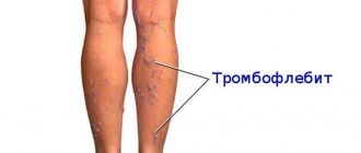 Тромбофлебит нижних конечностей