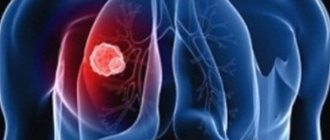 Pulmonary tuberculosis