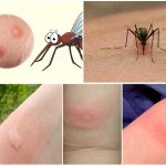 Mosquito bite