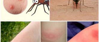 Mosquito bite