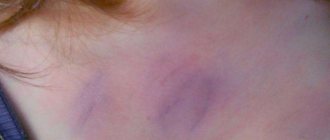 Chest bruise