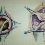 ушивание разрыва шейки матки