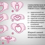 Узкий таз при беременности и родах: причины, классификация, признаки