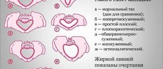 Узкий таз при беременности и родах: причины, классификация, признаки