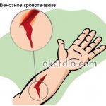 венозное кровотечение
