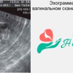 Type of cord on ultrasound