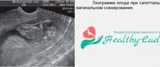 Вид тяжа на узи