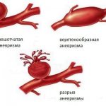виды аневризмы