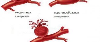 types of aneurysm