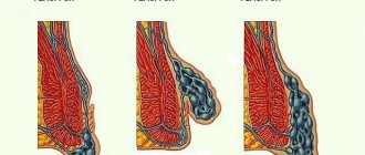 Types of hemorrhoids