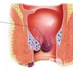 Внутренний геморрой часто ничем не проявляет себя на ранней стадии