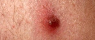 intradermal nevus