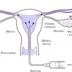 внутриматочная инсеминация спермой мужа