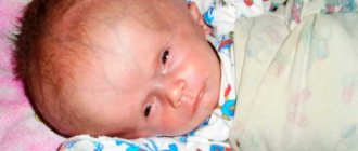 dropsy in a baby