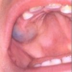 Gum inflammation during teething in children