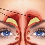 Воспаление лобных пазух