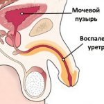 Inflamed urethra with urethritis