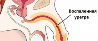 Inflamed urethra with urethritis