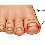 Ingrown toenails are a fairly common problem.