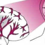 Все, что нужно знать об инфаркте головного мозга