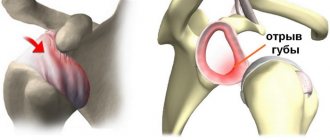 Shoulder dislocation