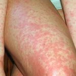 Заразна ли скарлатина для окружающих взрослых