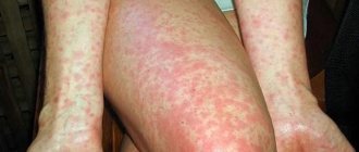 Заразна ли скарлатина для окружающих взрослых