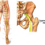 Pinched sciatic nerve
