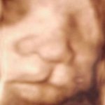 Заячья губа на 3Д УЗИ