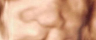 Cleft lip on 3D ultrasound