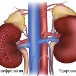 Здоровая и больная диабетический нефропатией почка человека