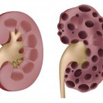 здоровая почка и почка с поликистозом